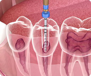 About care teeth